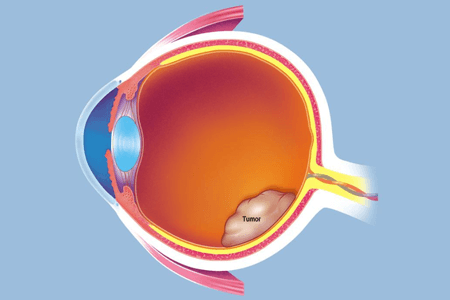 撅眼最快的治療方法是什么 需要如何防止復發(fā)？