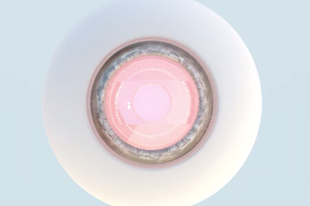 依鏡PRL晶體植入術(shù)注意事項(xiàng)，尤其第二步！